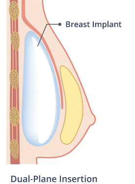 Breast Augmentation Implants Huntsville AL Tennessee Valley