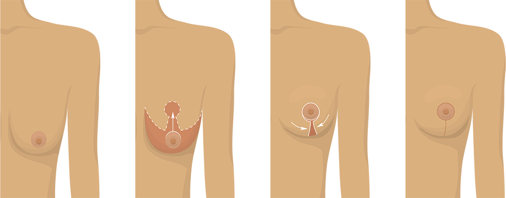 Procedure infographic